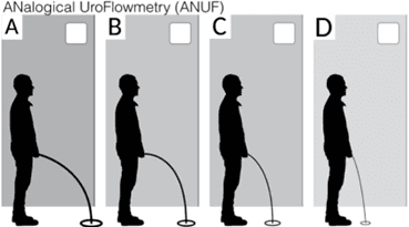 ANUF Piktogramm zur Selbsteinschätzung des Harnstrahls: Stufe A (stark) bis Stufe D (schwach)